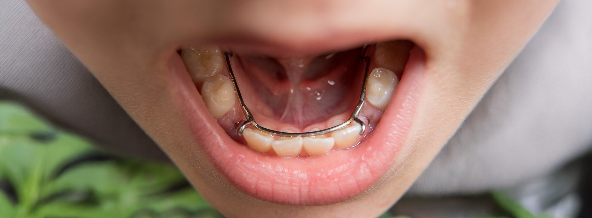 Lighthouse Kids Dental | Space Maintainers, Pediatric Dentistry and Preventative Care